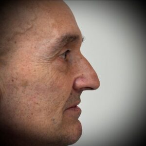 Rinoplastia ultrasónica en Bilbao 10