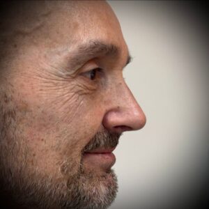 Rinoplastia ultrasónica en Bilbao 11