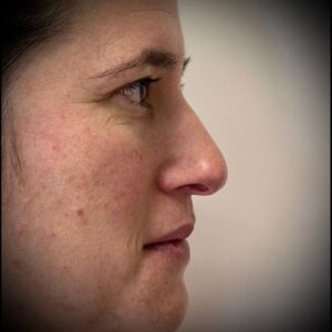 Rinoplastia ultrasónica en Bilbao 8