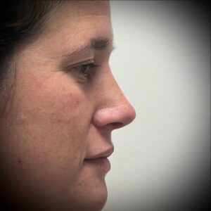 Rinoplastia ultrasónica en Bilbao 9