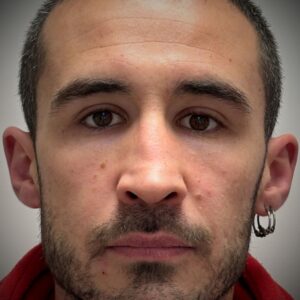 rinoplastia con cartílago costal 5