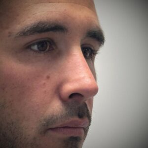 rinoplastia con cartílago costal 9