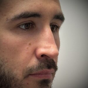 rinoplastia con cartílago costal 10