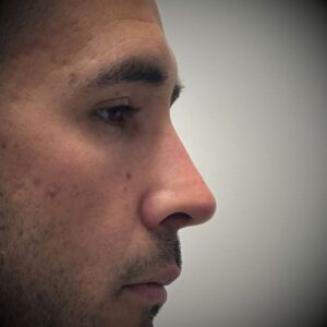 Rinoplastia ultrasónica en Bilbao 7