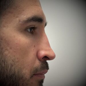 Rinoplastia ultrasónica en Bilbao 6