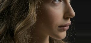 Perfil nasal femenino: dorso y punta de la nariz en una rinoplastia ultrasónica en Bilbao