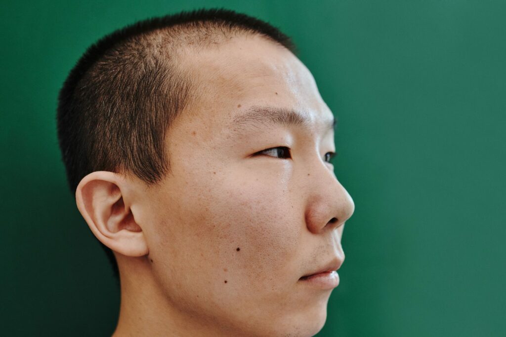 Perfil masculino con dorso nasal recto tras una septorrinoplastia en Bilbao
